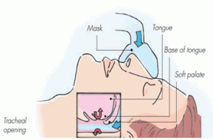 Positive Airway Pressure